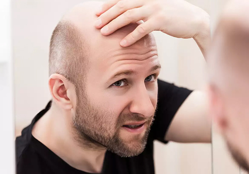 hair loss management